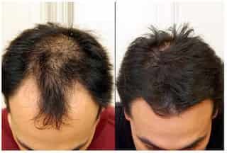 laser-hair-treatment-clinics-044pxx44xx44131118201428f5r9-8jiijst